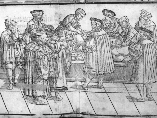 Kaiserschnitt (bzw. Laparotomie) unter der Leitung von Mathias Cornax (1549)