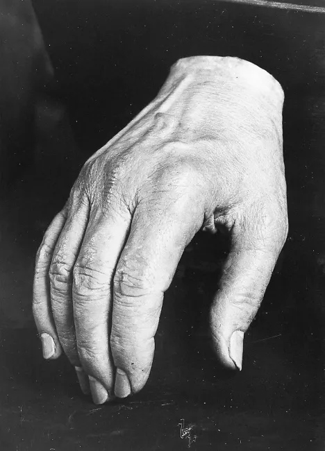 Die Hand des Chirurgen Anton von Eiselsberg (1860–1939)