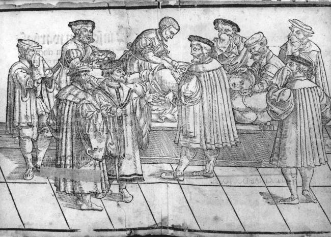 Kaiserschnitt (bzw. Laparotomie) unter der Leitung von Mathias Cornax (1549)